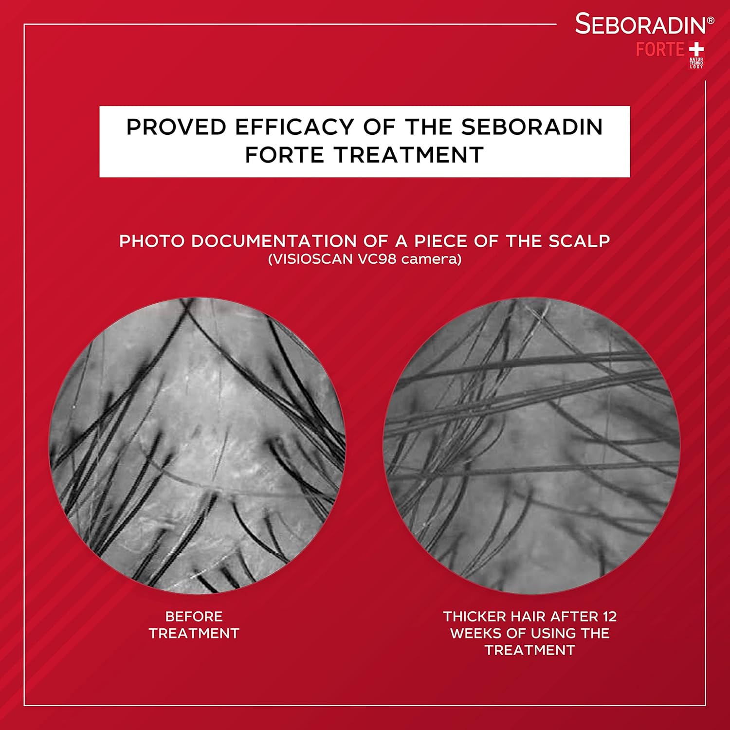 SEBORADIN ANTI HAIR LOSS LOTION 200ML #15552 4