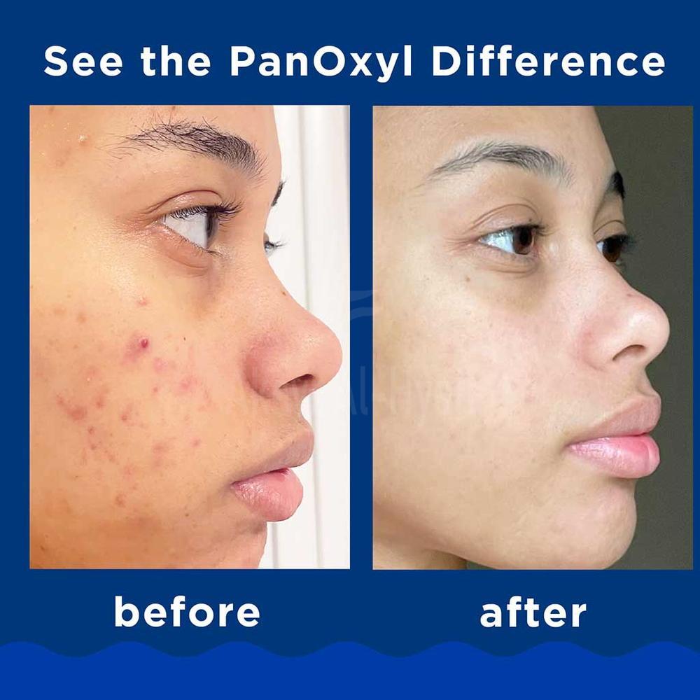 PANOXYL BENZOYL 10% ACNE FOAMING WASH 156G 2
