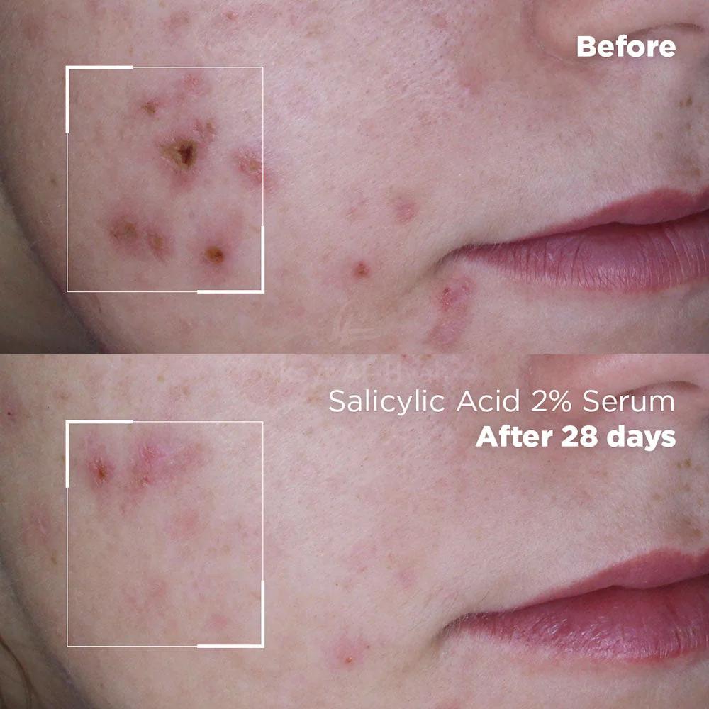 SKIN REPUBLIC SALICYLIC ACID 2% SERUM 30ML 3