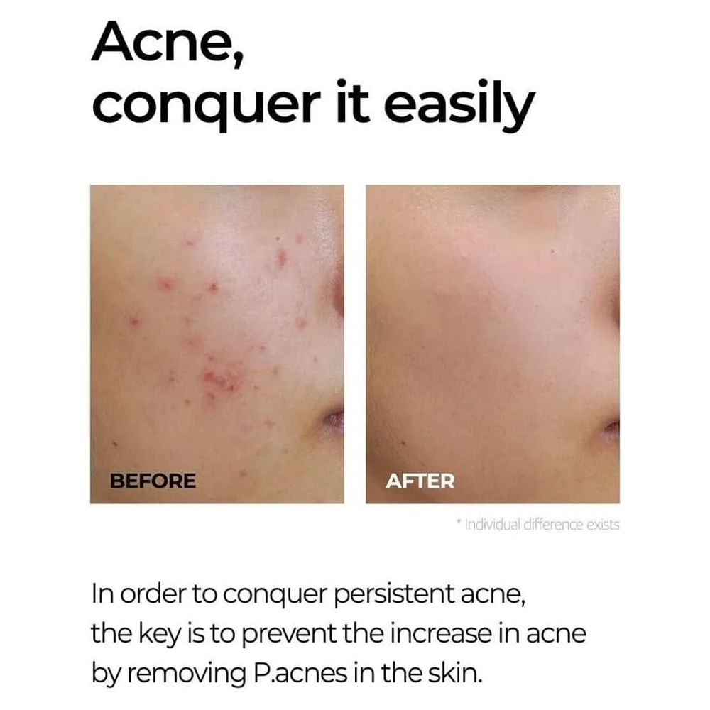 SOME BY MI MIRACLE AC CLEAR SPOT TREATMENT 10ML #587128 1